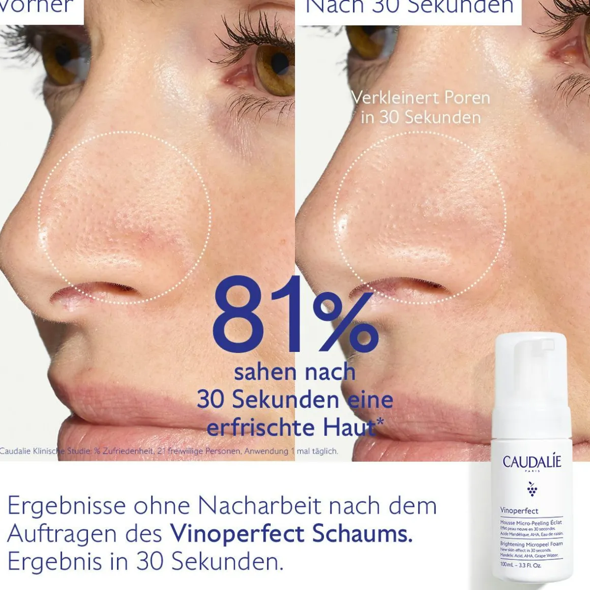 Mikro-Peeling Schaum Ausstrahlung mit Mandelsäure (AHA) - 50mL