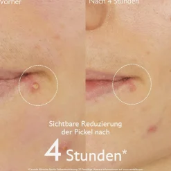 Pickel-Stopp mit Salicylsäure