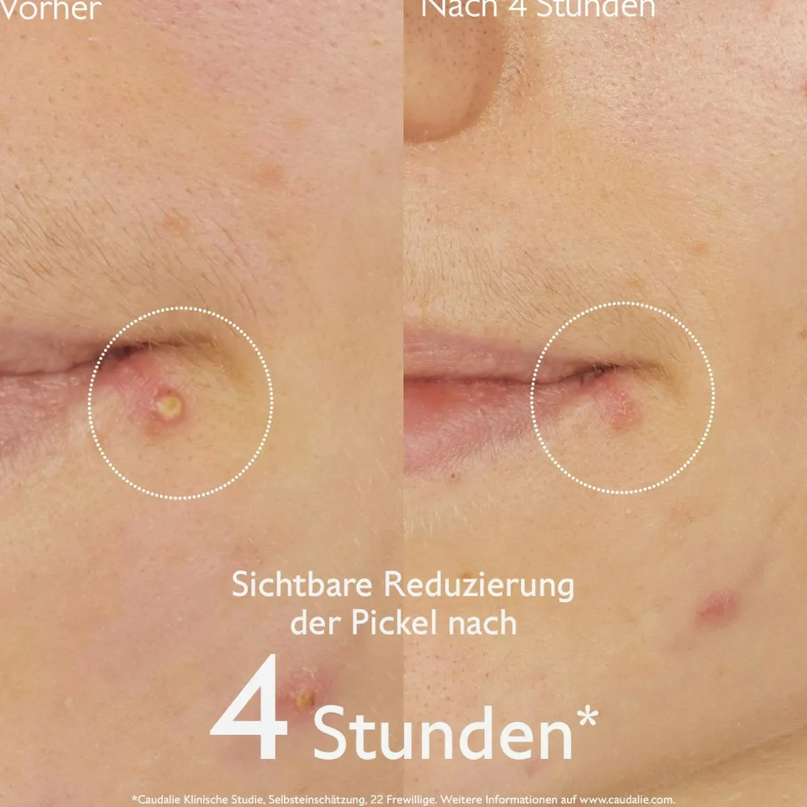 Pickel-Stopp mit Salicylsäure